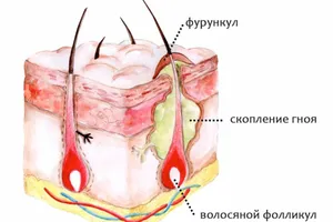 Фурункулез — причины, симптомы, лечение, профилактика Фурункулез — причины, симптомы, лечение, профилактика